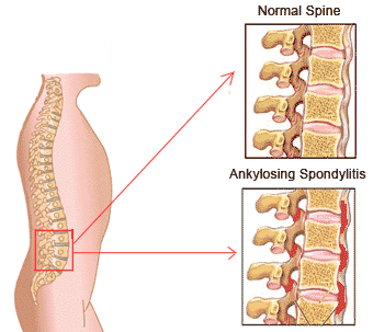 Ankylosing Spondylitis-Life Homeo Care